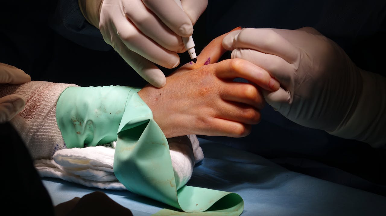 Close-up of surgeons performing a delicate wrist surgery in an operating room.